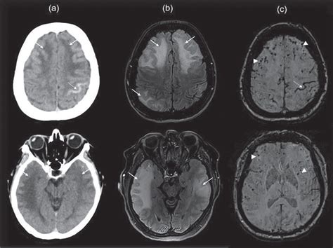 Updated Outlook Of Cerebral Amyloid Angiopathy And Inflammatory