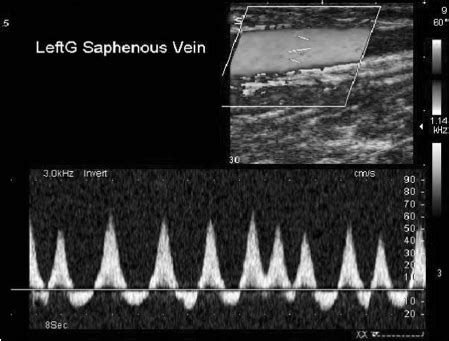 Retrograde Pulsatile Flow In The Left Great Saphenous Vein On Duplex