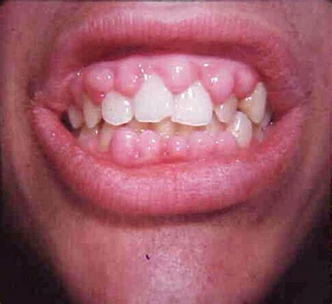 Gingivitis ~ Causes, Symptoms And Prevention ~ Abeyek