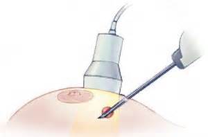 Microbiopsie Mammaire Radiologie Imagerie Tzanck