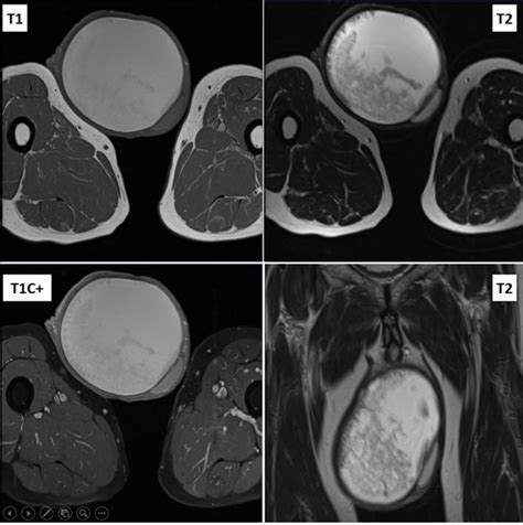 Testicular Rupture Ultrasound