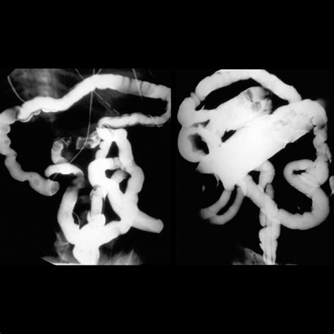 Meconium Ileus Uncomplicated | Pediatric Radiology Reference Article ...