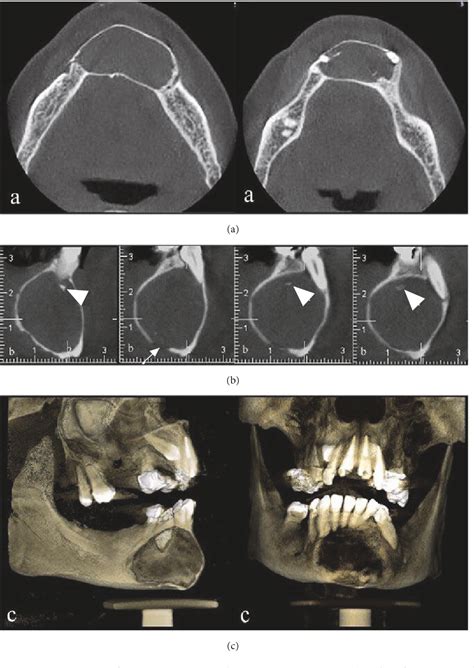 Figure 2 From An Extrafollicular Adenomatoid Odontogenic Tumor