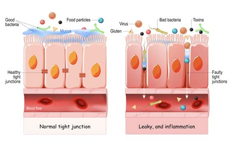 Das Leaky Gut Syndrom Alles über das Reizdarmsyndrom Symptome Abhilfe