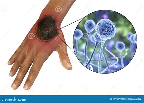 Cutaneous Mucormycosis, a Disease Caused by Fungi Mucor, Also Known As Black Fungus Stock ...