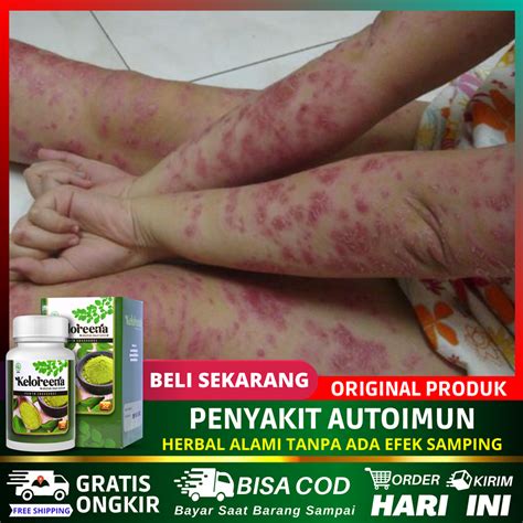 Jual Obat Autoimun Penyakit Kulit Lupus Psoriasis Ruam Kulit Demam