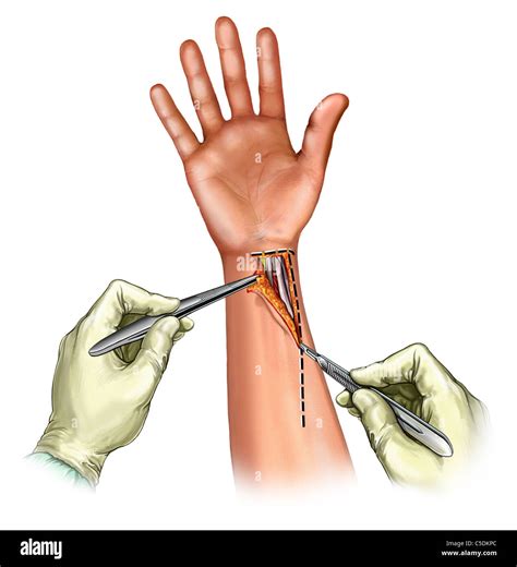 Henry S Approach Incision To Expose The Distal Radius For Internal