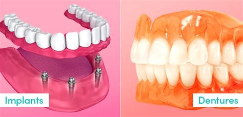 The Differences Between Dentures And Dental Implants