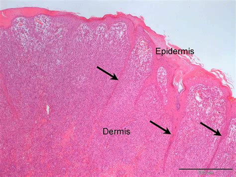 A benign cutaneous histiocytoma in a pug | Case Study | Cytopath