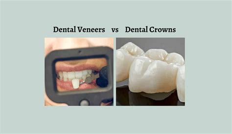 Dental Veneers vs. Dental Crowns: What’s the Difference?