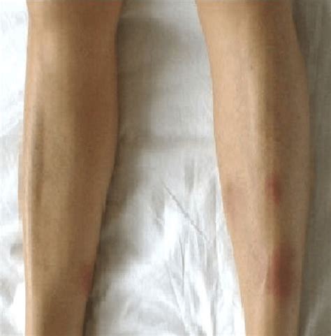 Multiple Erythematous Papular Nodular Skin Lesions On Both Legs Download Scientific Diagram