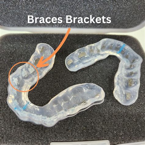 Your Braces Step By Step Guide From Braces On To Braces Off