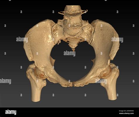 Ct Scan Of Pelvic Bone With Both Hip Joint 3d Rendering Image Inlet