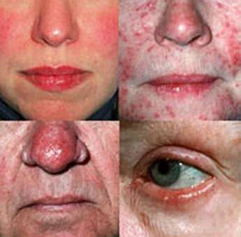 Ocular Rosacea - Pictures, Symptoms, Treatment and Causes