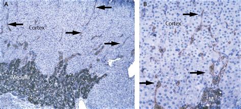 Congenital Adrenal Hyperplasia The Lancet