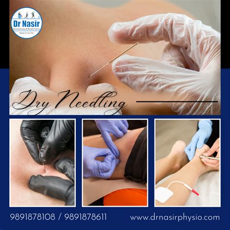 What Is Dry Needling Dr Nasirphysiotherapy And Rehabilation