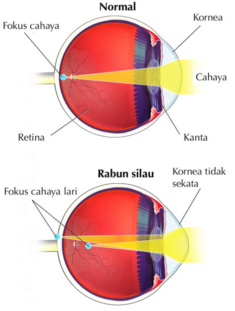 Rabun Silau Punca Tanda Dan Rawatan Tips Kesihatan