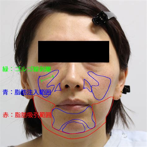 ★136【ゴルゴ線剥離】頬・顎下ベイザー 脂肪注入 右頬ゴルゴ剥離 シンシア総院長ブログ～sincerely Yours 銀座の美容外科