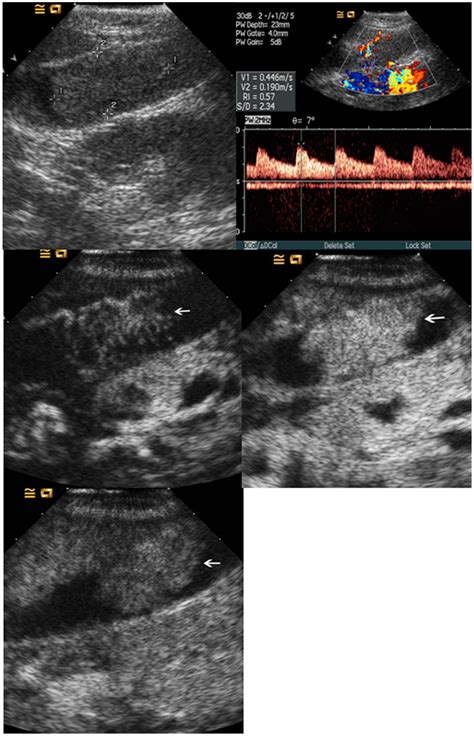 Adenoma in gallbladder. Upper left, conventional ultrasound shows an ...