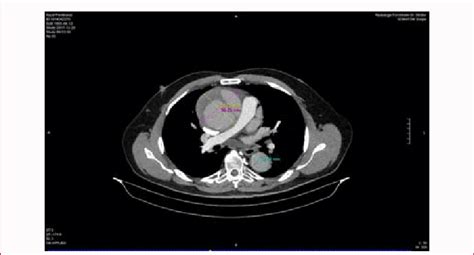 Pre Op Ct Scan Axial Ascending And Descending Aorta Download Scientific Diagram