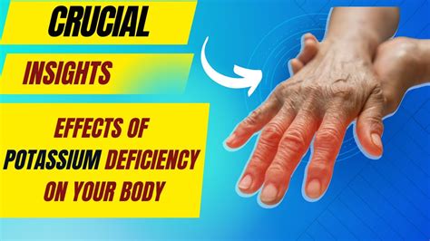 Signs Symptoms And Solutions For Potassium Deficiency Dietary Tips To Prevent Potassium