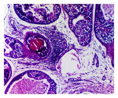 Histological Views Of Prostatic Inflammation In All Groups Normal