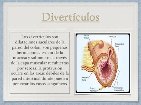 Diverticulitis