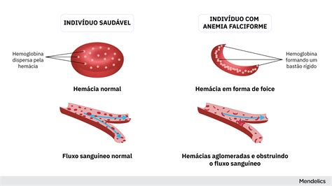 Anemia Falciforme Entenda O Que é Blog Mendelics