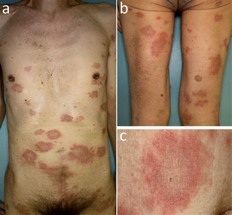 Erythematous Variety Of Bullous Pemphigoid Case Report And Literature