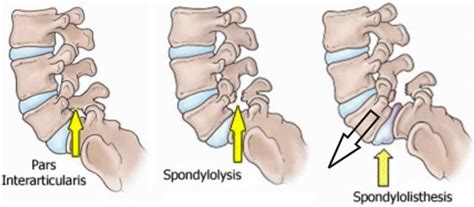 spondylolisthesis  symptoms diagnosis grades treatment