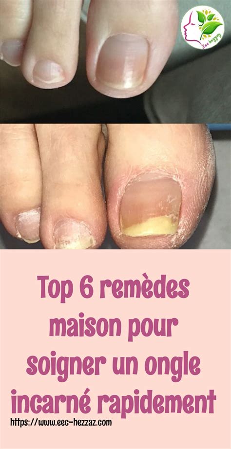 Top Rem Des Maison Pour Soigner Un Ongle Incarn Rapidement