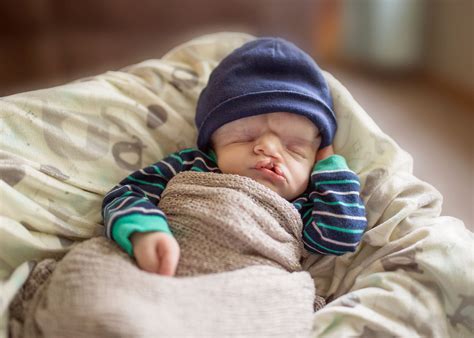 'I love him the way he is': Family shares joy of having baby born with