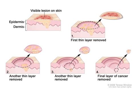 Mohs Micrographic Surgery Pictures Photos