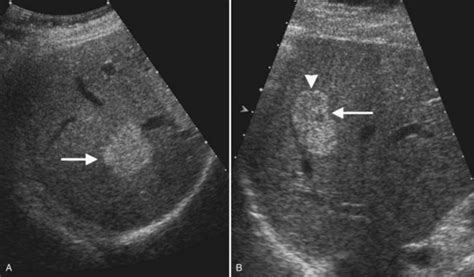 Liver Masses Ultrasound