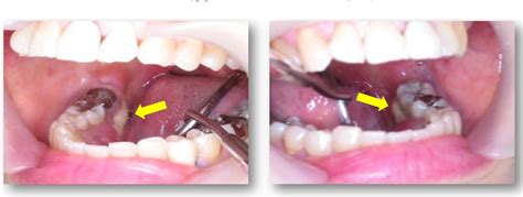 Novel Insight Into The Management Of Bisphosphonate Related Osteonecrosis Of The Jaw Bronj