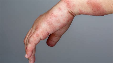 Skin Allergies Symptoms And Treatment For Itchy Skin