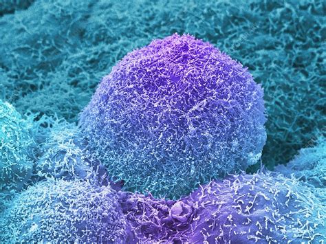 Prostate Cancer Cells SEM Stock Image C051 1074 Science Photo