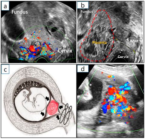 Successful Full Term Delivery Via Selective Ectopic Embryo Reduction