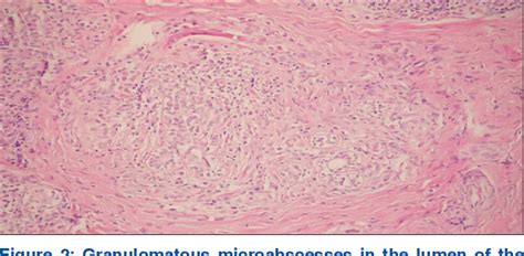 Figure From Plantar Erythema Nodosum Associated With Granulomatous