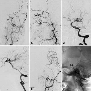 Complicated aneurysm of the posterior communicating artery with ...