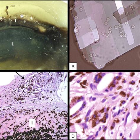 A Clinical Photograph Of The Left Eye Anterior Segment Showing