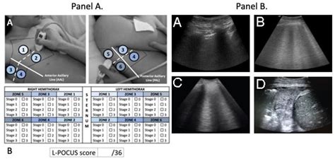 Point Of Care Ultrasonography For Risk Stratification Of Non Critical