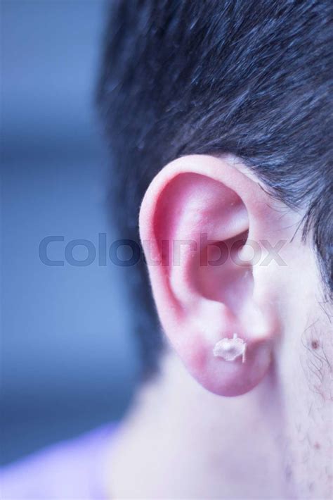 Auriculartherapy Ear Seed Treatment Stock Image Colourbox