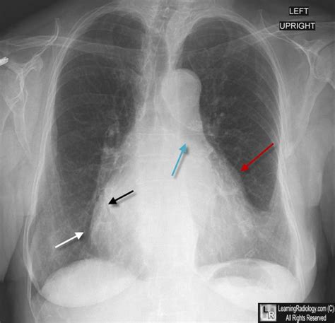 Learningradiology Mitral Stenosis Ms