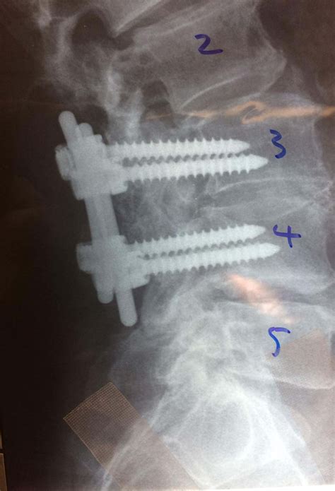 Artificial Cervical Disc Replacement - OrthoSpine NY