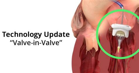 Surgeon Q A Valve In Valve Therapy For Small Tissue Valves Heart