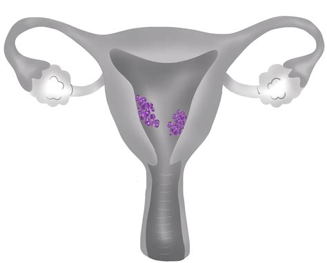 Rak endometrium immunoterapia podnosi skuteczność leczenia