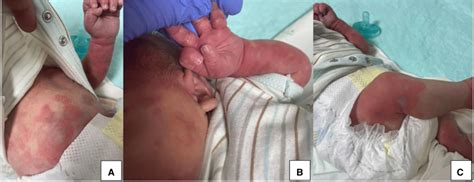 Annular Erythema of Infancy Grupo de Patología Infecciosa AEPap