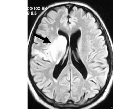 Basal Ganglia Infarct Mri