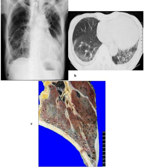 Ijerph Free Full Text Clinical Radiological And Pathological